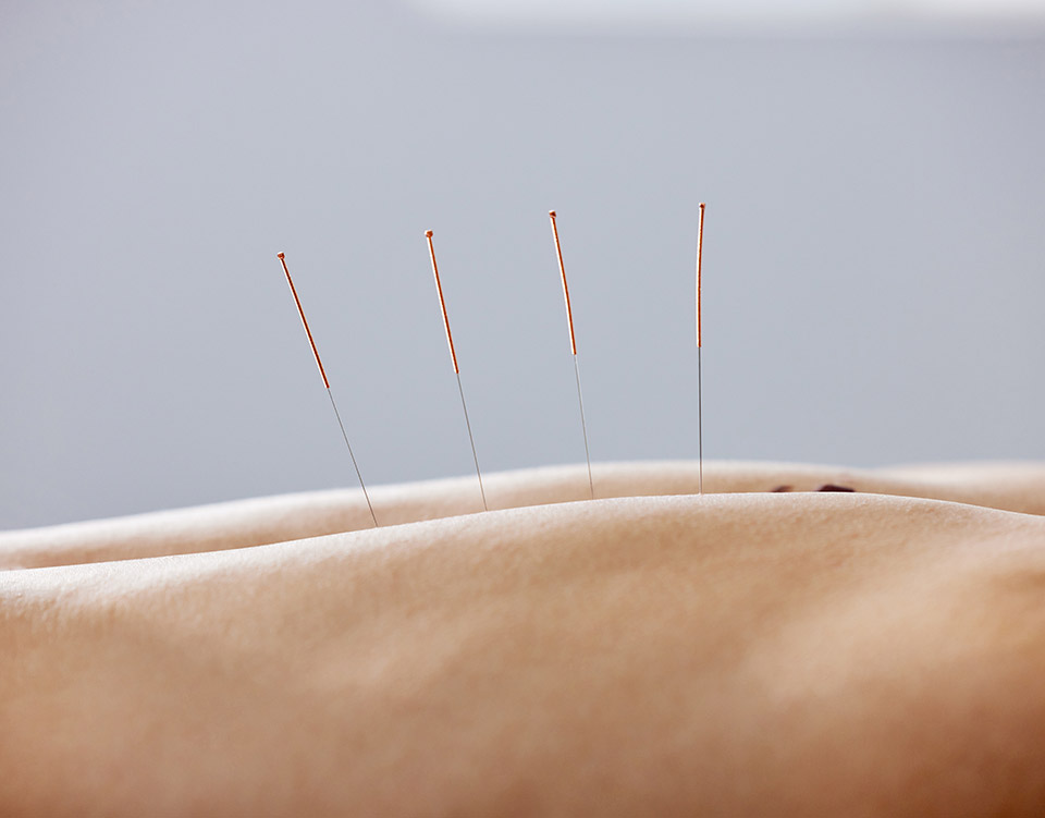 Dry needling Töölö Bella Amore